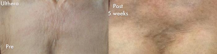 Patient 4404, Ulthera before and after photos Ulthera before and after photos in Bay Harbor Islands, FL, Patient 4404