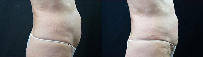  before and after photos in Bay Harbor Islands, FL, Ultrashape Power Treatment in Miami, FL