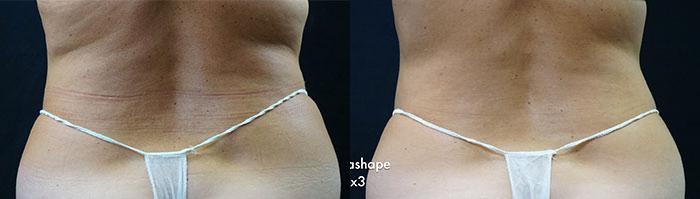 UltraShape before and after photos in Bay Harbor Islands, FL, Patient 4413