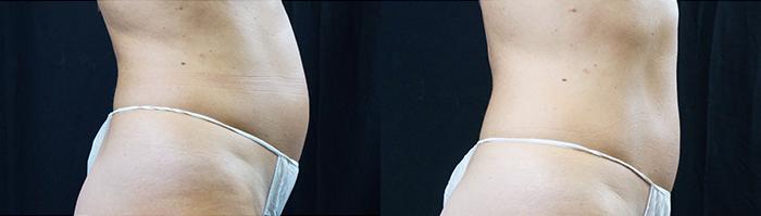 before and after photos in Bay Harbor Islands, FL, Ultrashape Power Treatment in Miami, FL