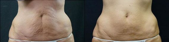 Velashape before and after photos in Bay Harbor Islands, FL