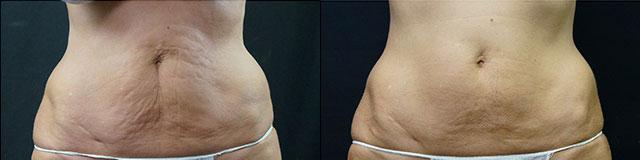 Velashape Iii Velashape Syneron Home Use Velashape Machine Buy Velashape Iii Velashape Syneron Home Use Velashape Machine Product On Alibaba Com