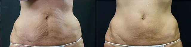  before and after photos in Bay Harbor Islands, FL, VelaShape Treatments to Reduce Cellulite