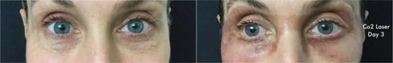 Patient 5300, Laser Resurfacing before and after photos Laser Resurfacing before and after photos in Bay Harbor Islands, FL, Patient 5300