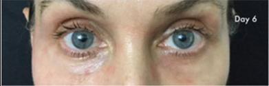 Patient 5300, Laser Resurfacing before and after photos Laser Resurfacing before and after photos in Bay Harbor Islands, FL, Patient 5300