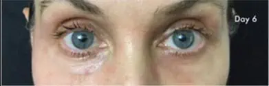 Patient 5300, Laser Resurfacing before and after photos Laser Resurfacing before and after photos in Bay Harbor Islands, FL, Patient 5300