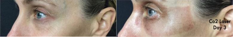 Patient 5300, Laser Resurfacing before and after photos Laser Resurfacing before and after photos in Bay Harbor Islands, FL, Patient 5300