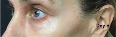 Patient 5300, Laser Resurfacing before and after photos Laser Resurfacing before and after photos in Bay Harbor Islands, FL, Patient 5300