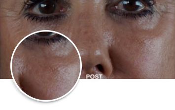 Laser Resurfacing, before and after, Miami