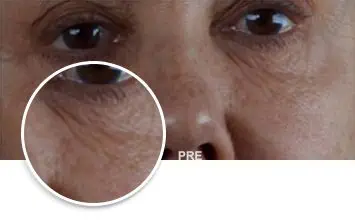 Laser Resurfacing, before and after, Miami