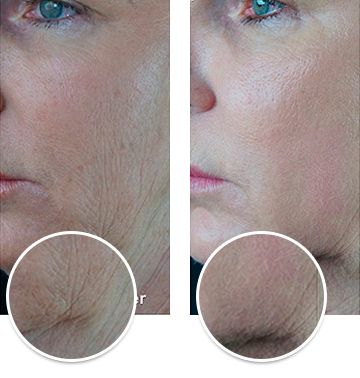 Laser Skin Resurfacing before and after in Miami, FL Laser Skin Resurfacing, before and after, Miami