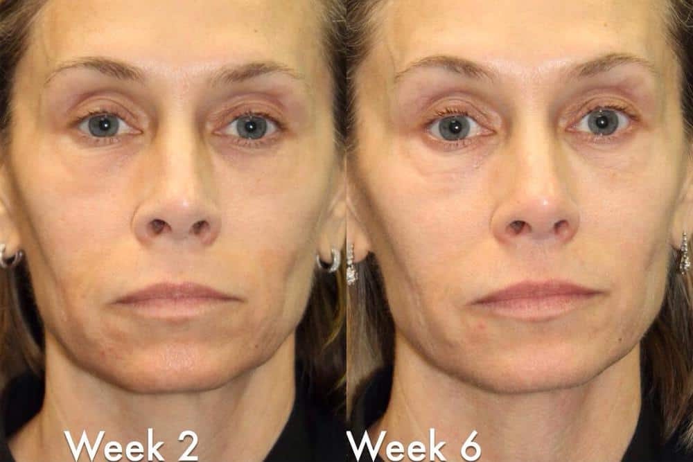 Laser Resurfacing before and after photos in Bay Harbor Islands, FL, Patient 6051