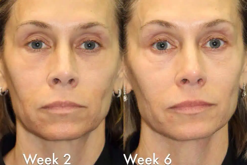 Laser Resurfacing before and after photos in Bay Harbor Islands, FL, Patient 6051