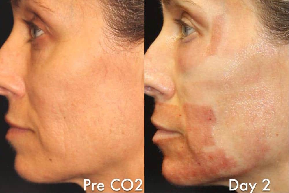 Laser Resurfacing before and after photos in Bay Harbor Islands, FL, Patient 6051