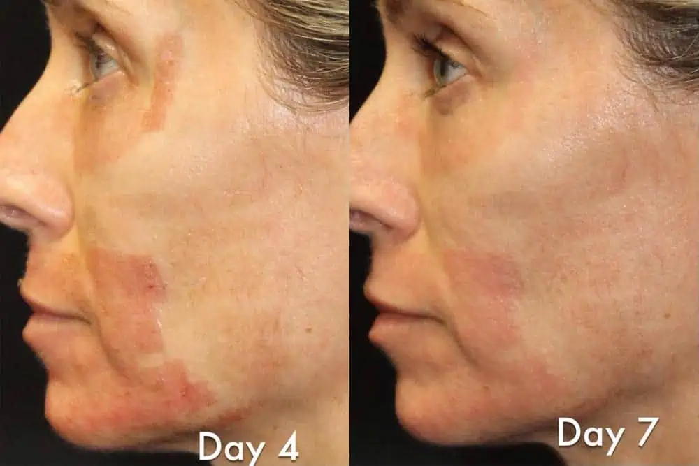 Laser Resurfacing before and after photos in Bay Harbor Islands, FL, Patient 6051