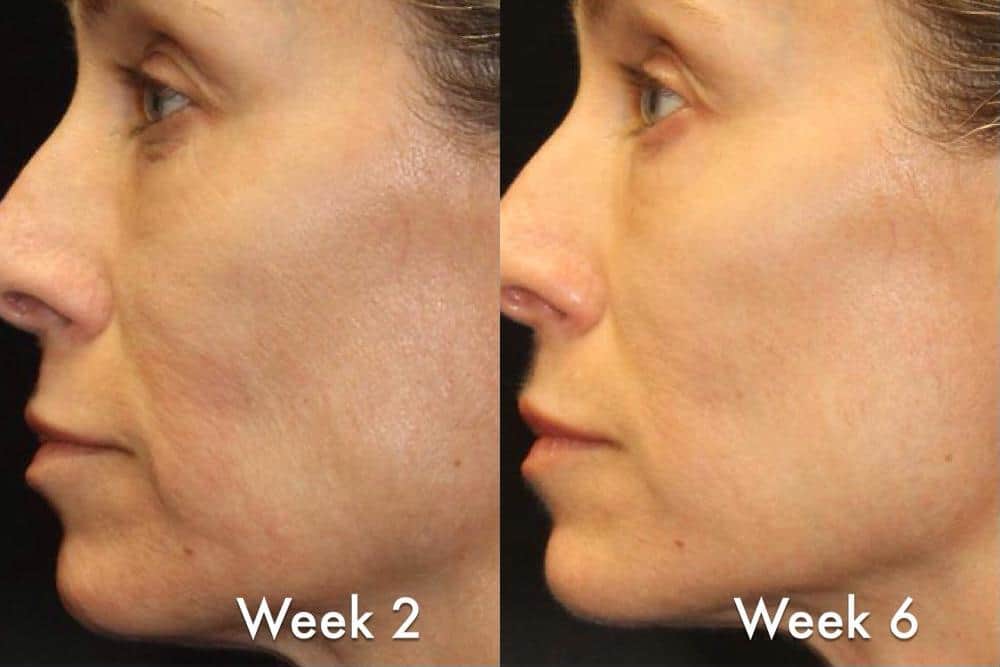 Laser Resurfacing before and after photos in Bay Harbor Islands, FL, Patient 6051
