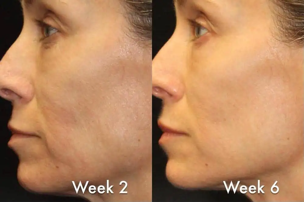 Laser Resurfacing before and after photos in Bay Harbor Islands, FL, Patient 6051