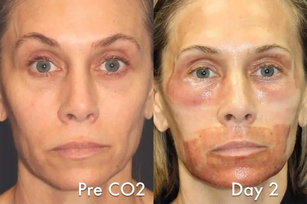 Fully Ablative CO2 Laser Resurfacing Treatment