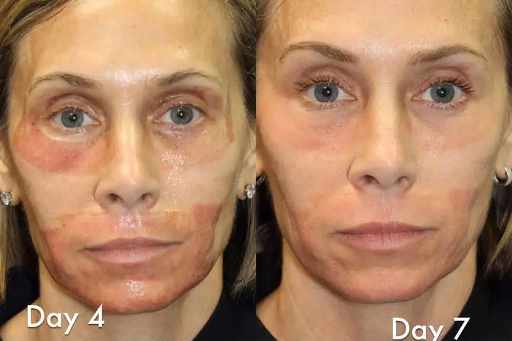 Laser Resurfacing before and after photos in Bay Harbor Islands, FL, Patient 6051