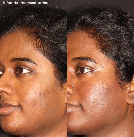 Patient 5686, E-Matrix before and after photos E-Matrix before and after photos in Bay Harbor Islands, FL, Patient 5686