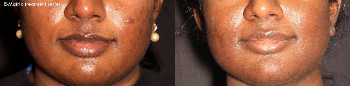 E-Matrix before and after photos in Bay Harbor Islands, FL, Patient 5686