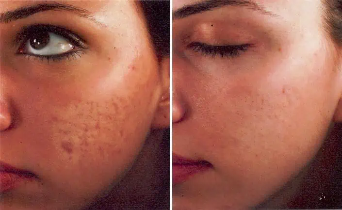  before and after photos in Bay Harbor Islands, FL, Acne Treatment in Miami, FL