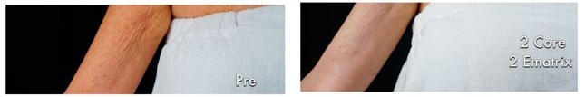 Patient 4296, E-Matrix before and after photos E-Matrix before and after photos in Bay Harbor Islands, FL, Patient 4296