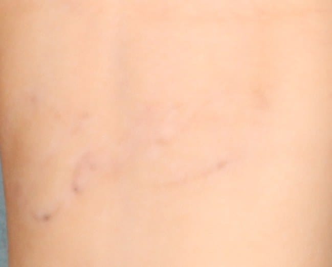 Skin Tightening & Skin Contouring in Bay Harbor Islands