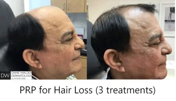 PRP for Hair Loss before and after photos in Bay Harbor Islands, FL