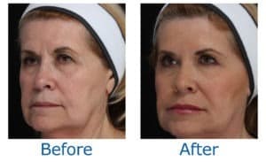 Picture of a woman before and after Ultherapy