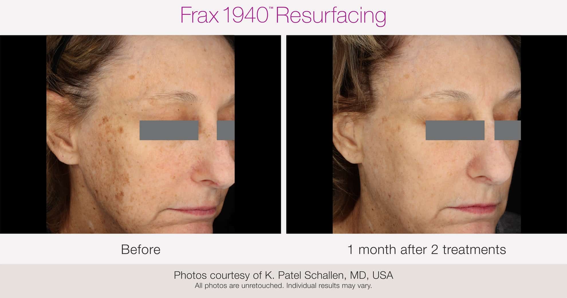Frax 1940 Resurfacing, before and after, Miami