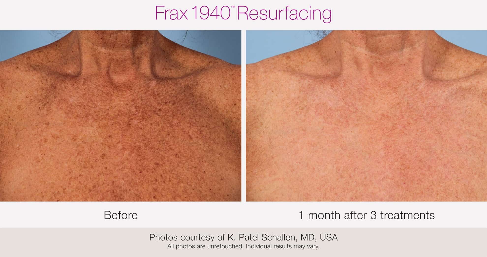 Frax 1940™ Resurfacing, before and after, Miami