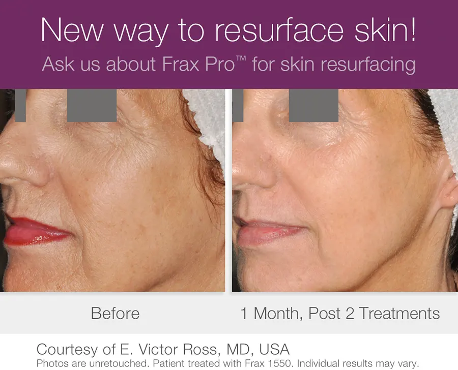 Frax Pro laser system, before and after