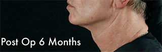 Ultherapy® in Bay Harbor Islands Ultherapy® in Bay Harbor Islands