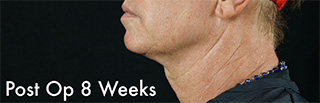 Bay Harbor Ultherapy® Treatment Bay Harbor Ultherapy® Treatment