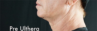 Florida Ultherapy® Florida Ultherapy®
